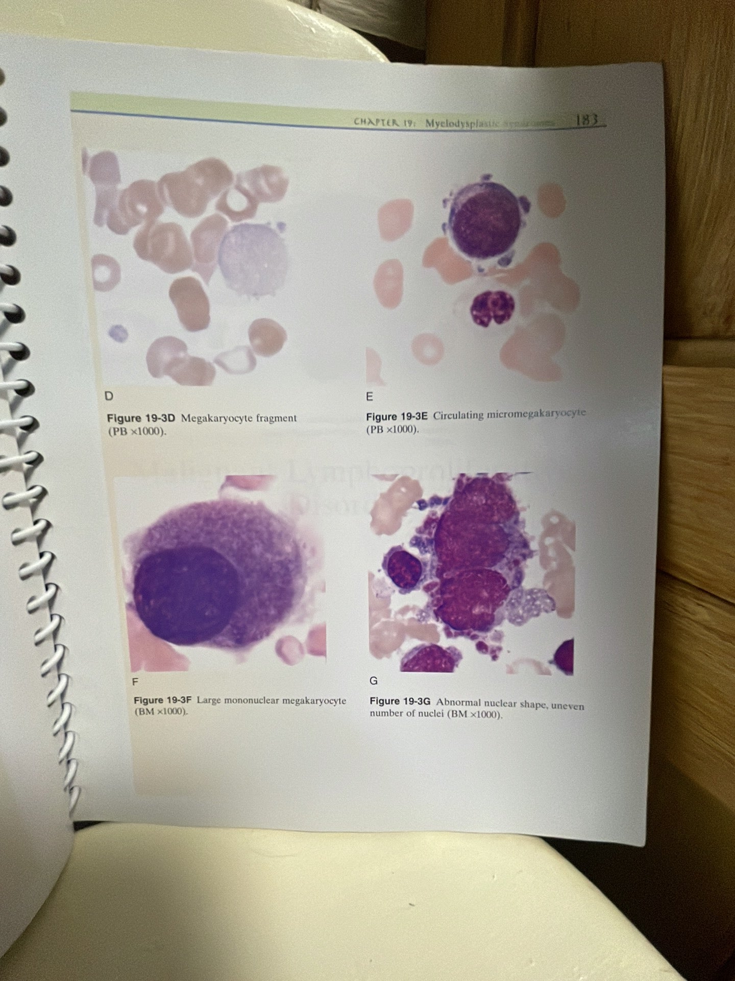 Clinical Hematology Atlas By Jacqueline H. Carr, Bernadette F. Rodak