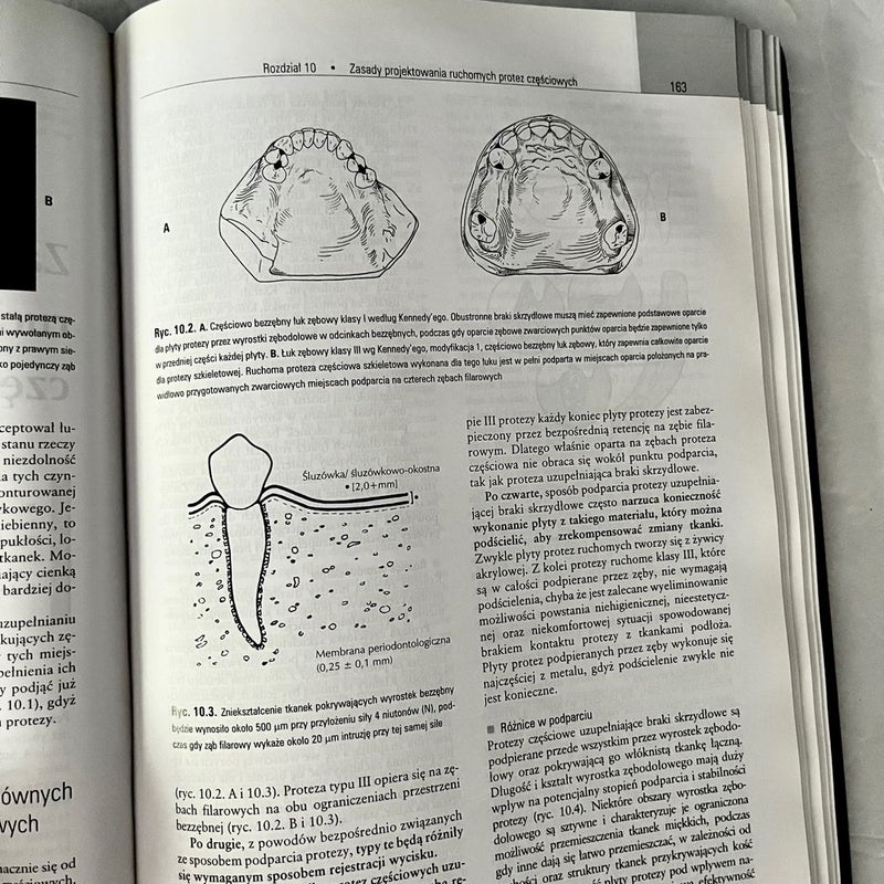 Polish Edition : Removable partial dentures