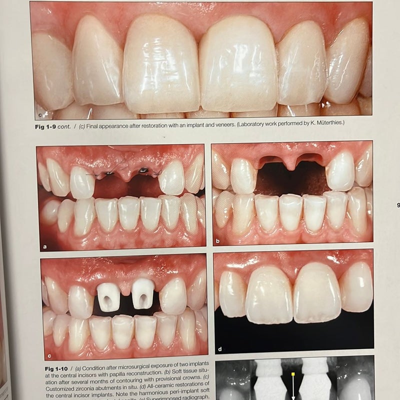 Techniques for Success with Implants in the Esthetic Zone